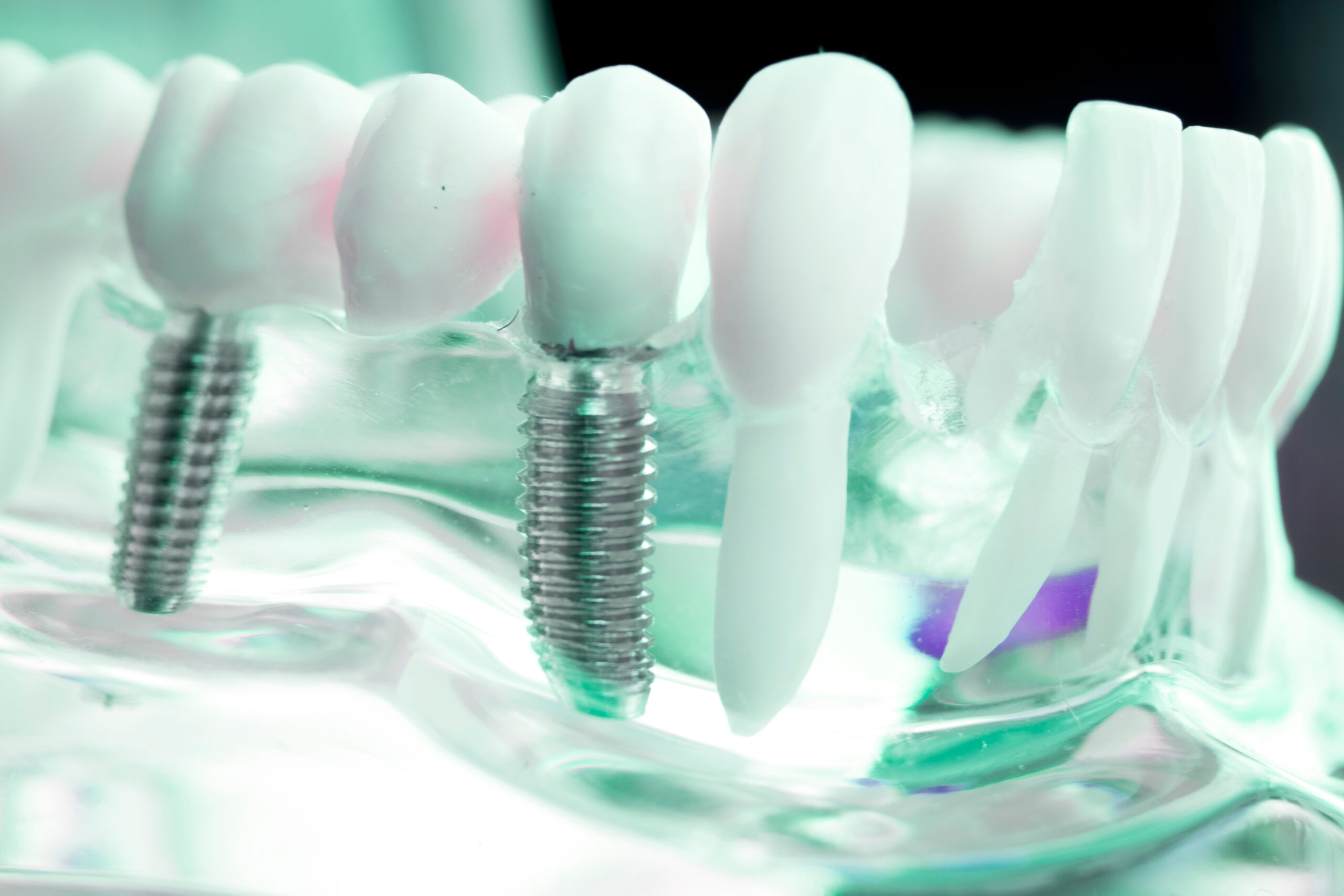 Dentist dental teeth implant